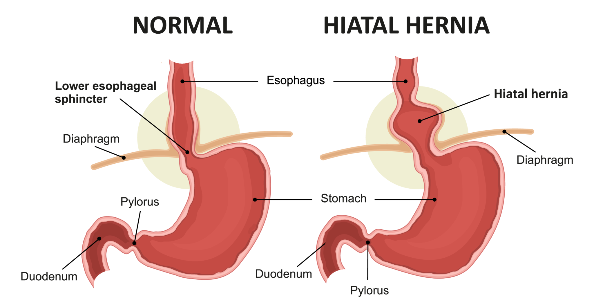 Genca Hernienchirurgie | Hernienoperation Wien | OA Dr. Matthias Hofmann